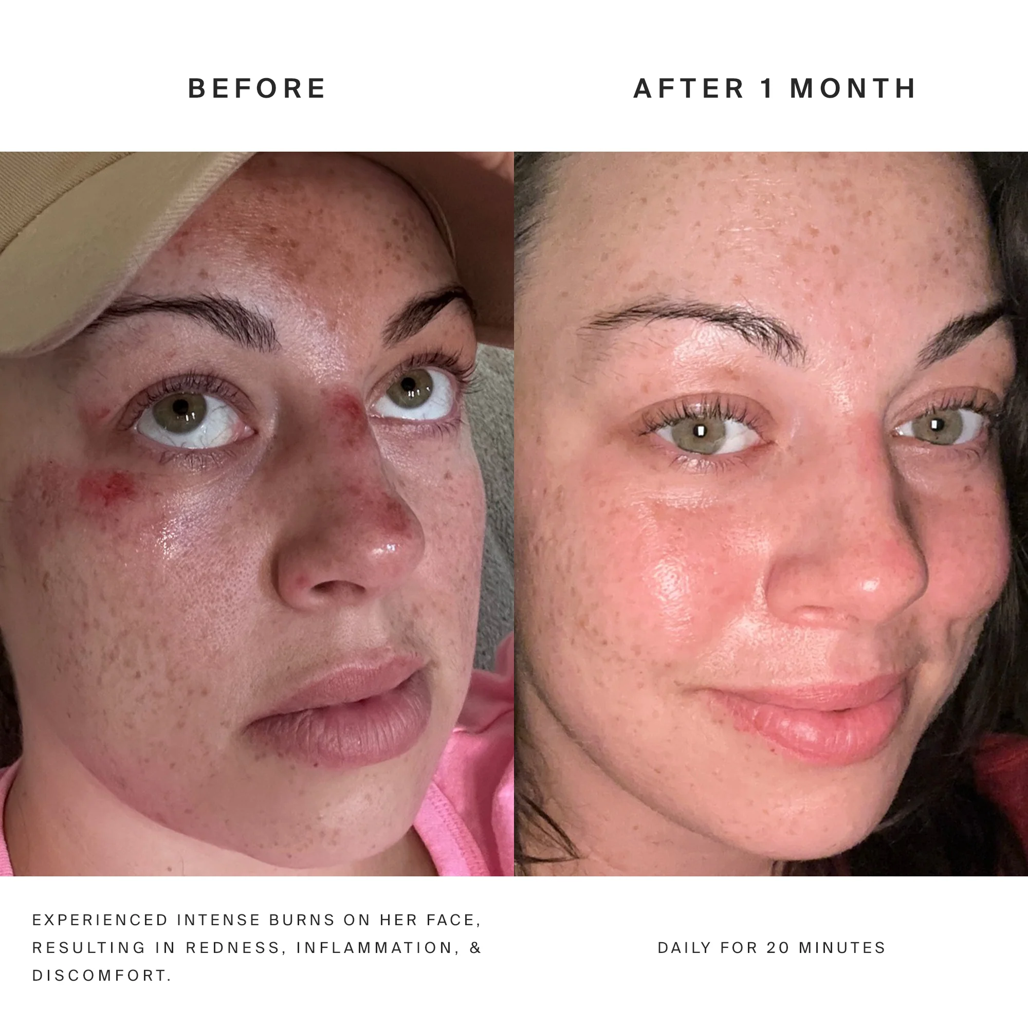 Higherdose Red Light Face Mask - Image 13